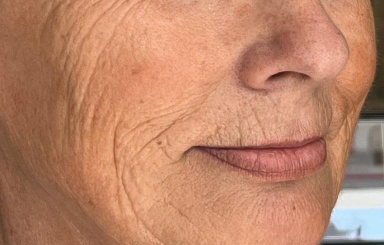 vor der Behandlung